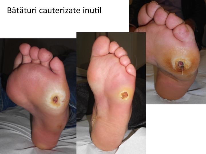 Mâncărimi ale pielii pe picioare cu tratament cu varice