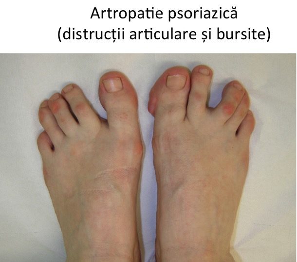 Artropatie psoriazica