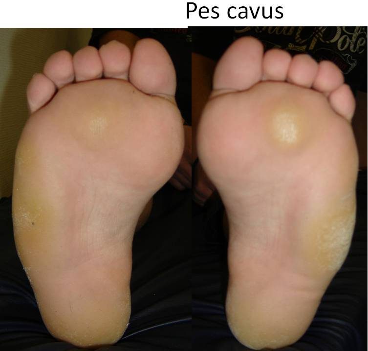 Batatura Pes cavus