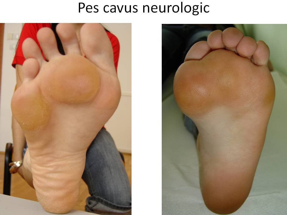 Batatura Pes cavus neurologic