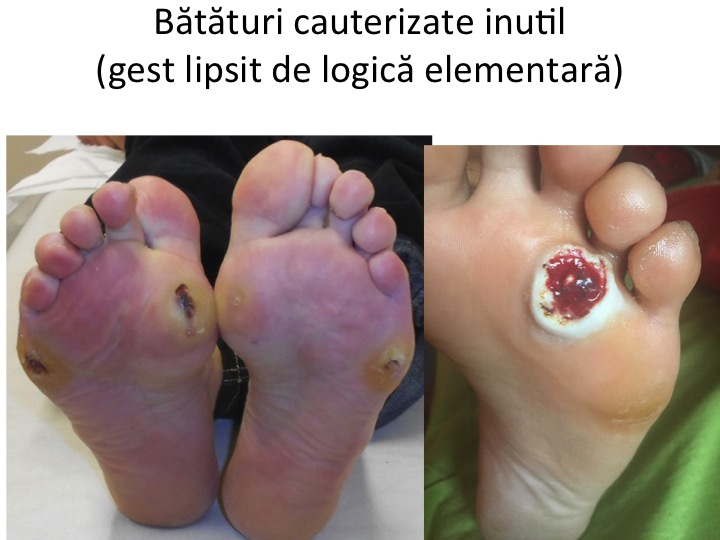 Batatura cauterizata plantar