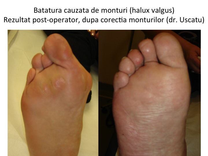 Batatura cauzata de monturi pre-post-op