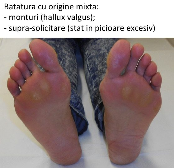 Batatura cu origine mixta