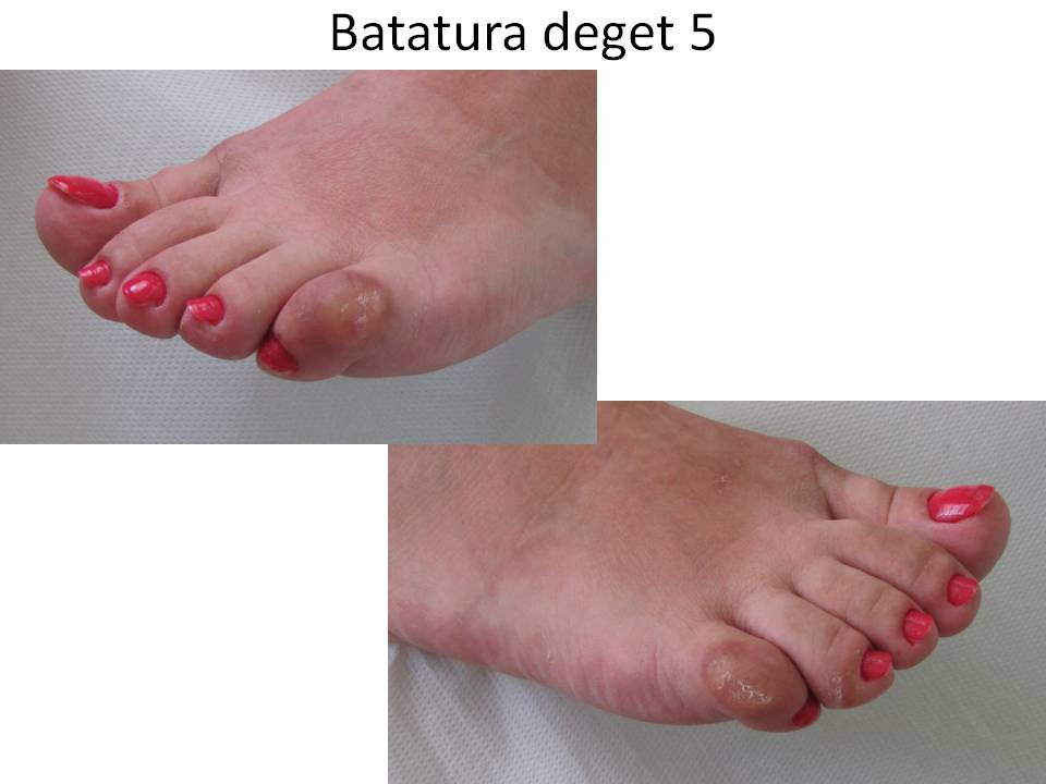 Batatura deget 5