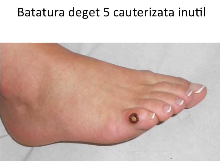 Batatura deget 5 cauterizata inutil