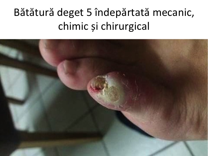 Batatura deget 5 cauterizata