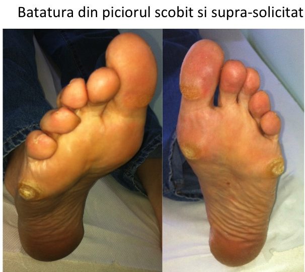 Batatura din picior scobit supra-solicitat