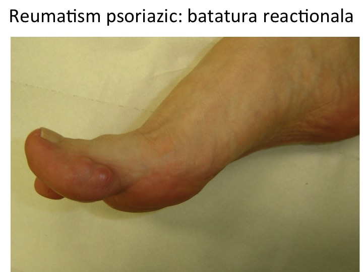 Batatura din reumatism psoriazic