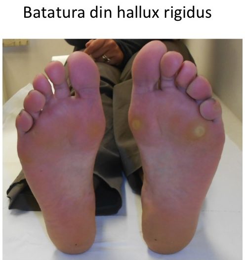 Batatura hallux rigidus