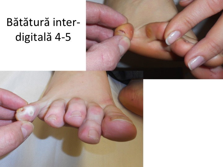 Batatura inter-digitala 4+ 5