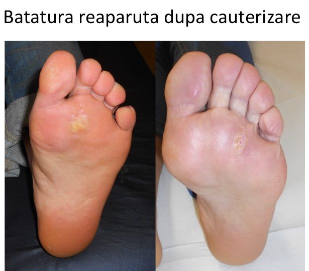 Batatura reaparauta dupa cauterizare