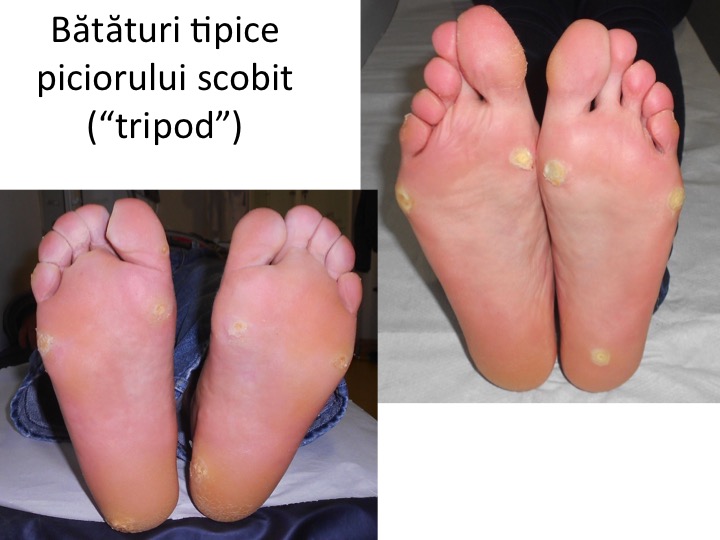 Bataturi calcaneene picior tripod