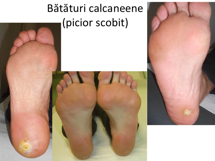 Bataturile Piciorului Cauze Si Tratament