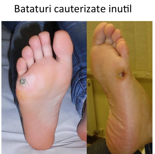 Bataturi cauterizate inutil