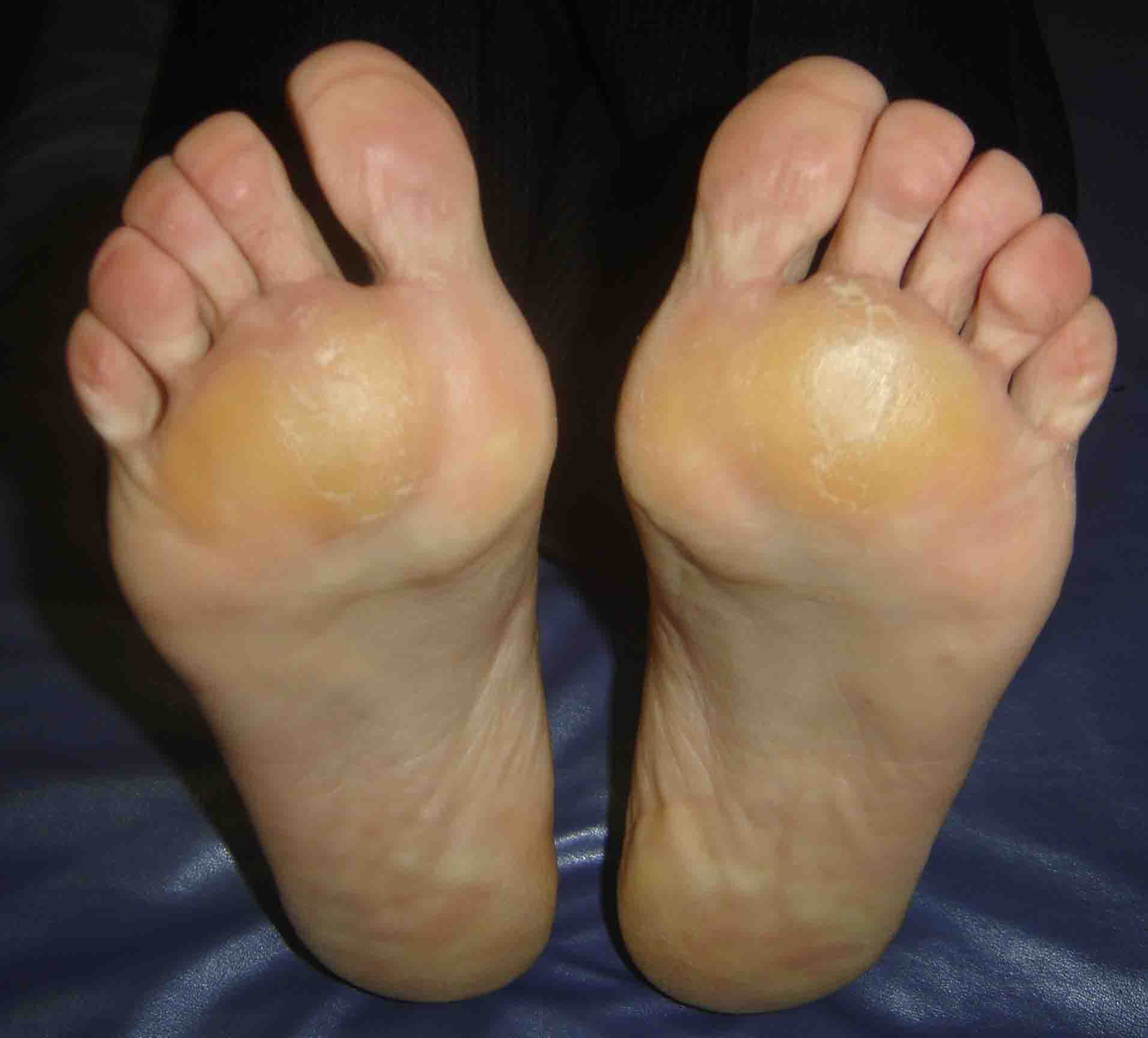 tratamentul artrozei piciorului și degetelor de la picioare)