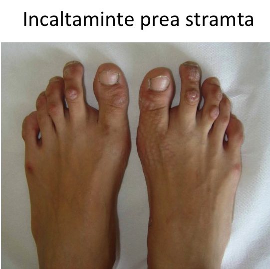 Bataturi degete-pantofi stramti