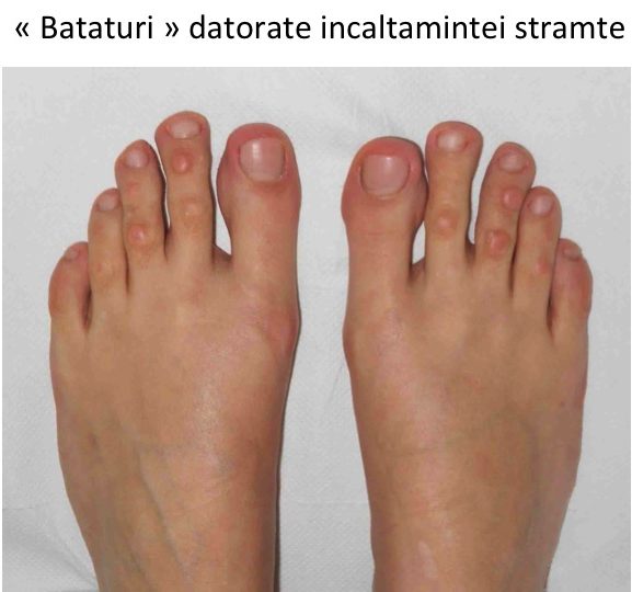 boala articulară a degetelor de la picioare