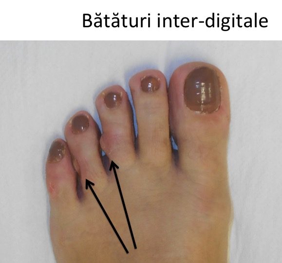 Bataturi inter-digitale 4 si 5