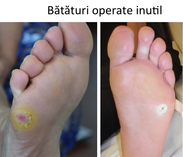 Bataturi operate inutil