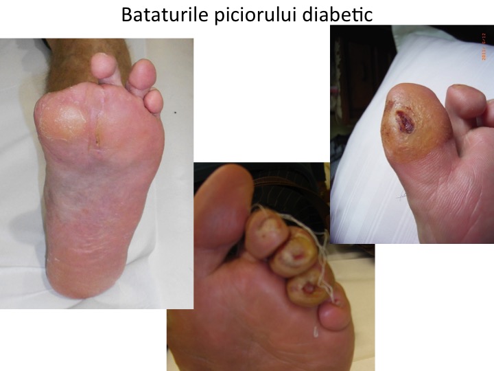 Bataturile piciorului diabetic