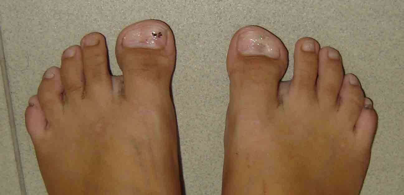 operatie degete picioare
