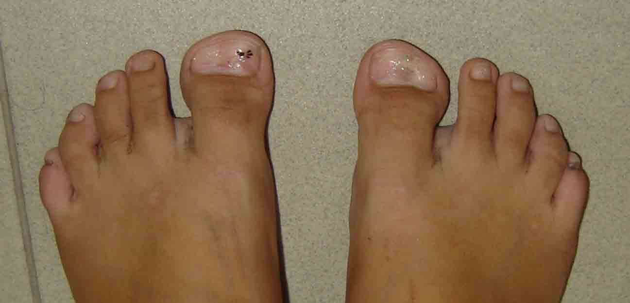 Monturile sau Hallux valgus | staru.ro