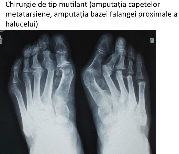 Chirurgie mutilanta Ale