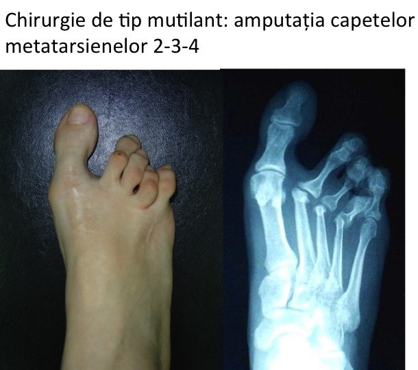 Chirurgie mutilanta Pa