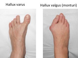 Comparatie Varus-valgus