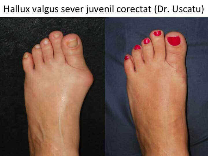 DL Hallux valgus juvenil