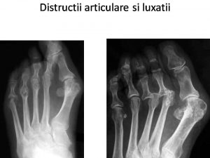 Distructii articulare si luxatii
