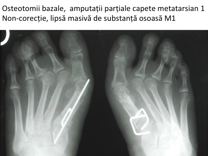 Esec bilateral Di osteotomii bazale