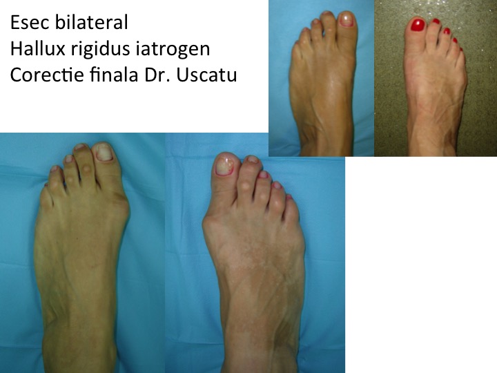 Esec bilateral HR iatrogen