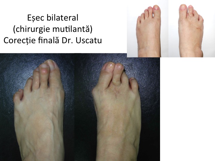 Esec bilateral Ia