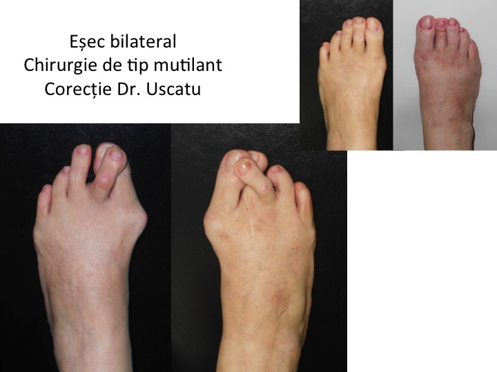 Esec bilateral Pal