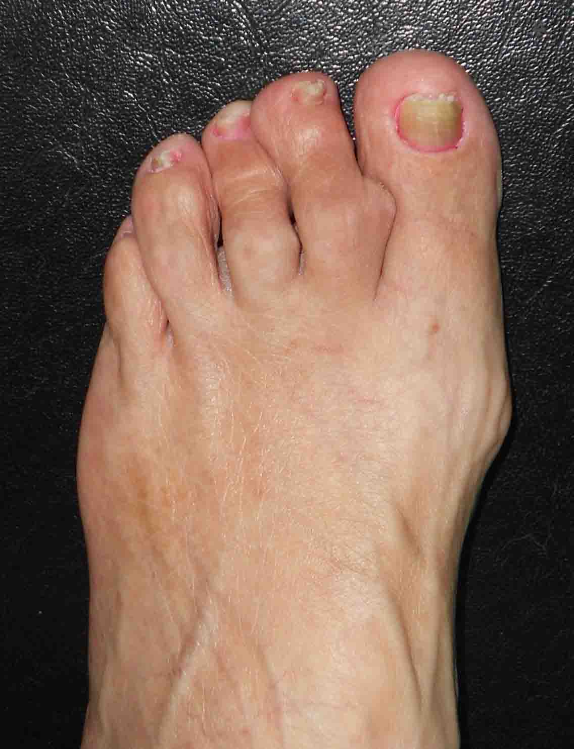artrita fractura de deget de la picior
