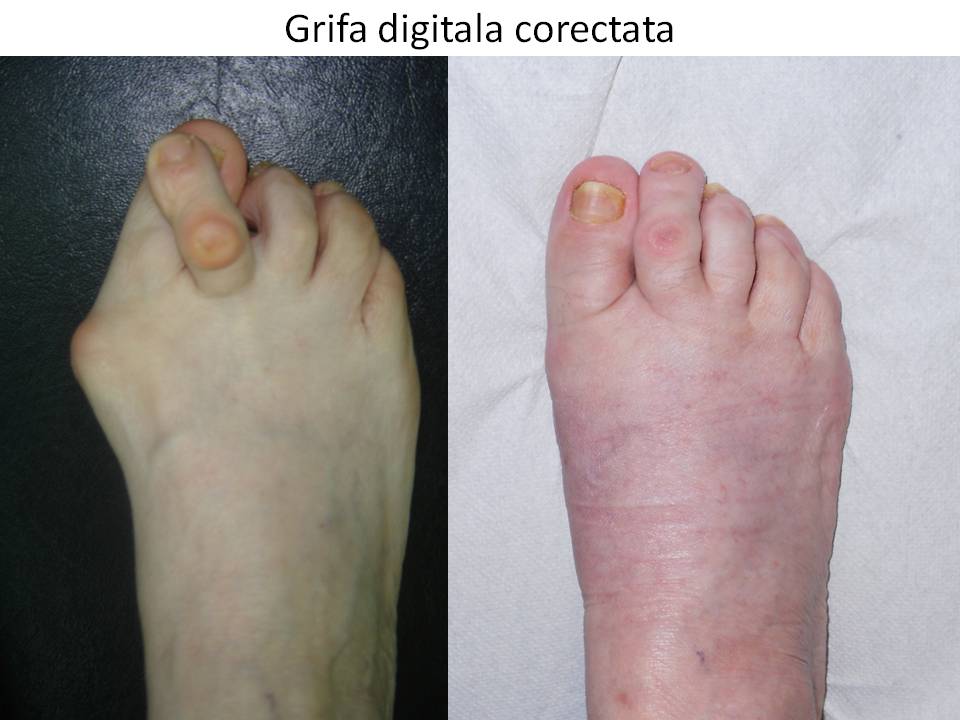 deteriorarea capsulei articulației degetului de la picior artrosuport gel pret