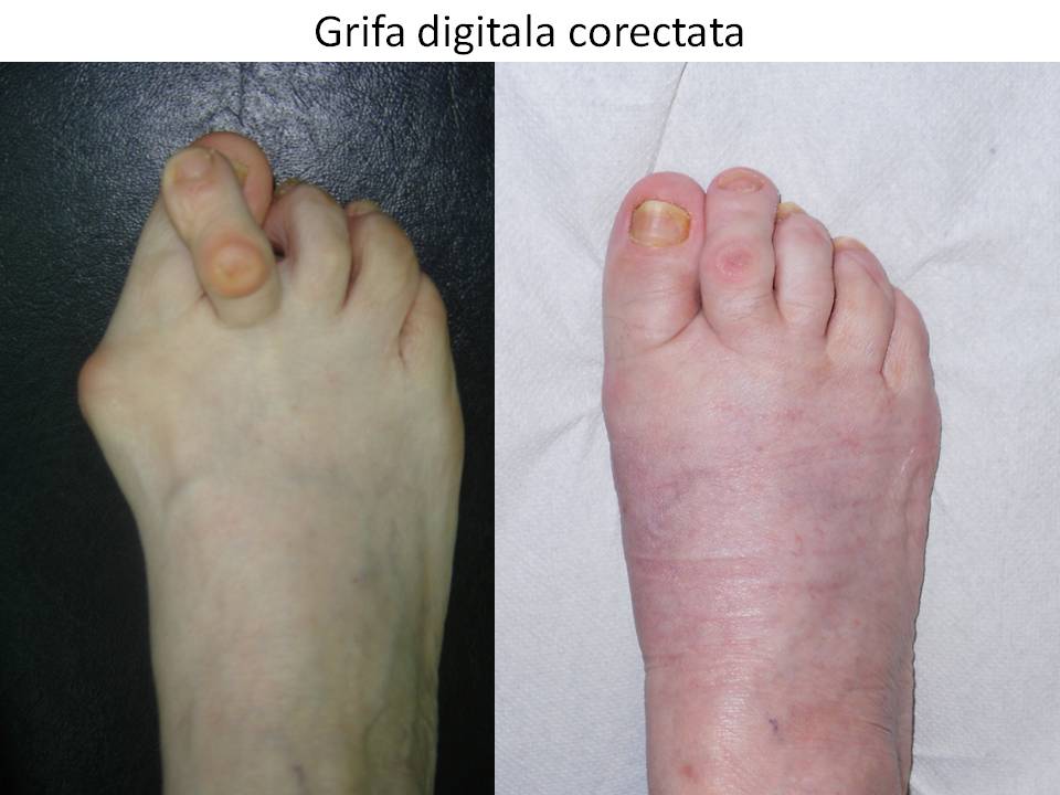 Grifa digitala corectata