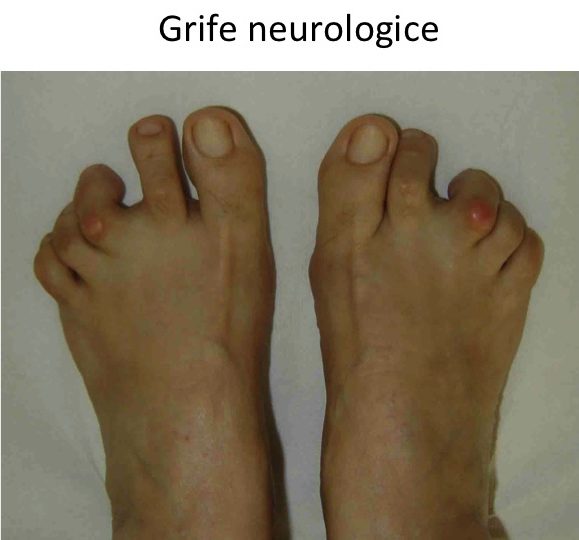 Grifa neurologica 2