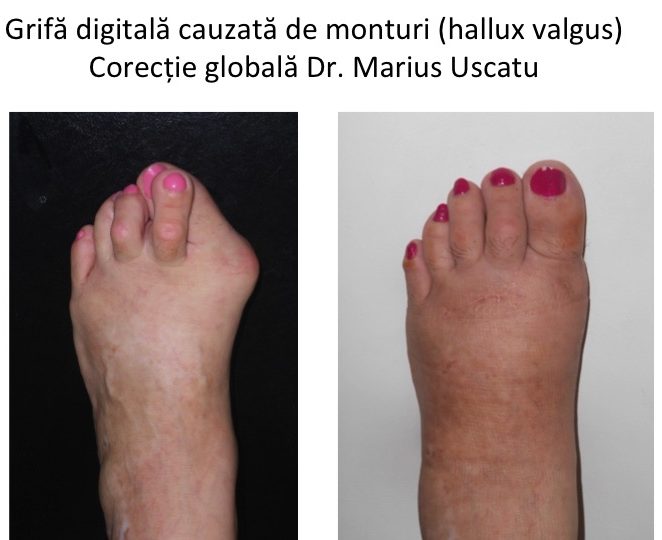 deformări ale degetelor de la picioare cu artrită)