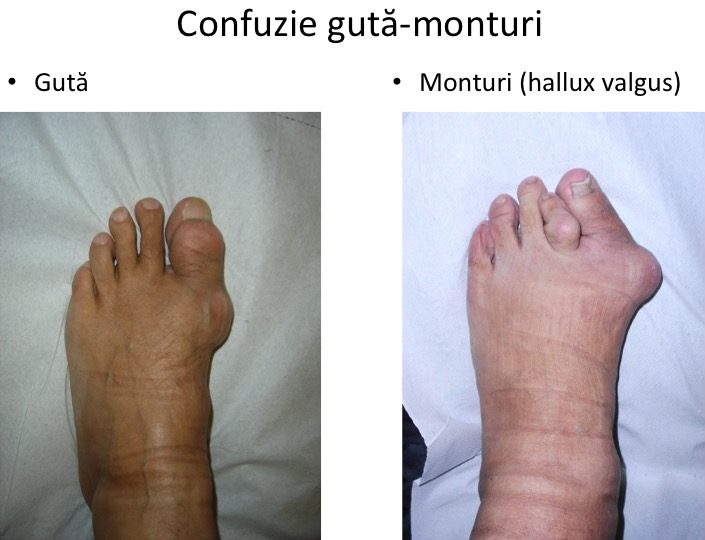 tratament cu artroza piciorului de gută