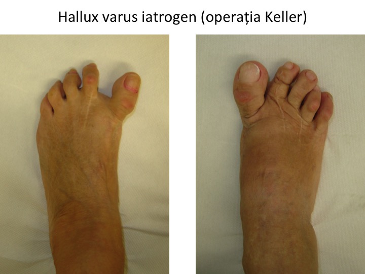 H varus iatrogen Keller