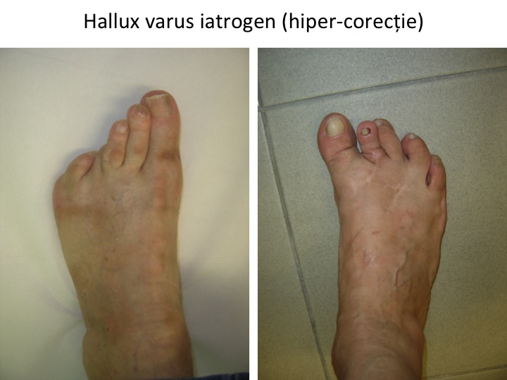 H varus iatrogen hiper-corectie