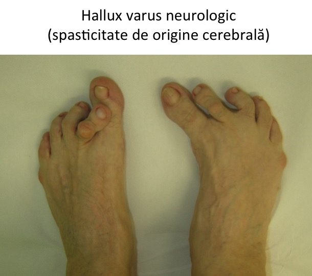 H varus neurologic cerebral