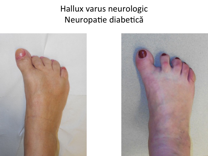 H varus neurologic diabet