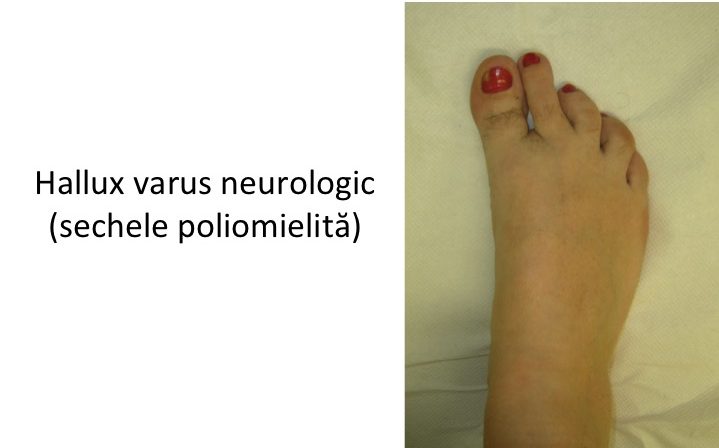 H varus neurologic poliomielita