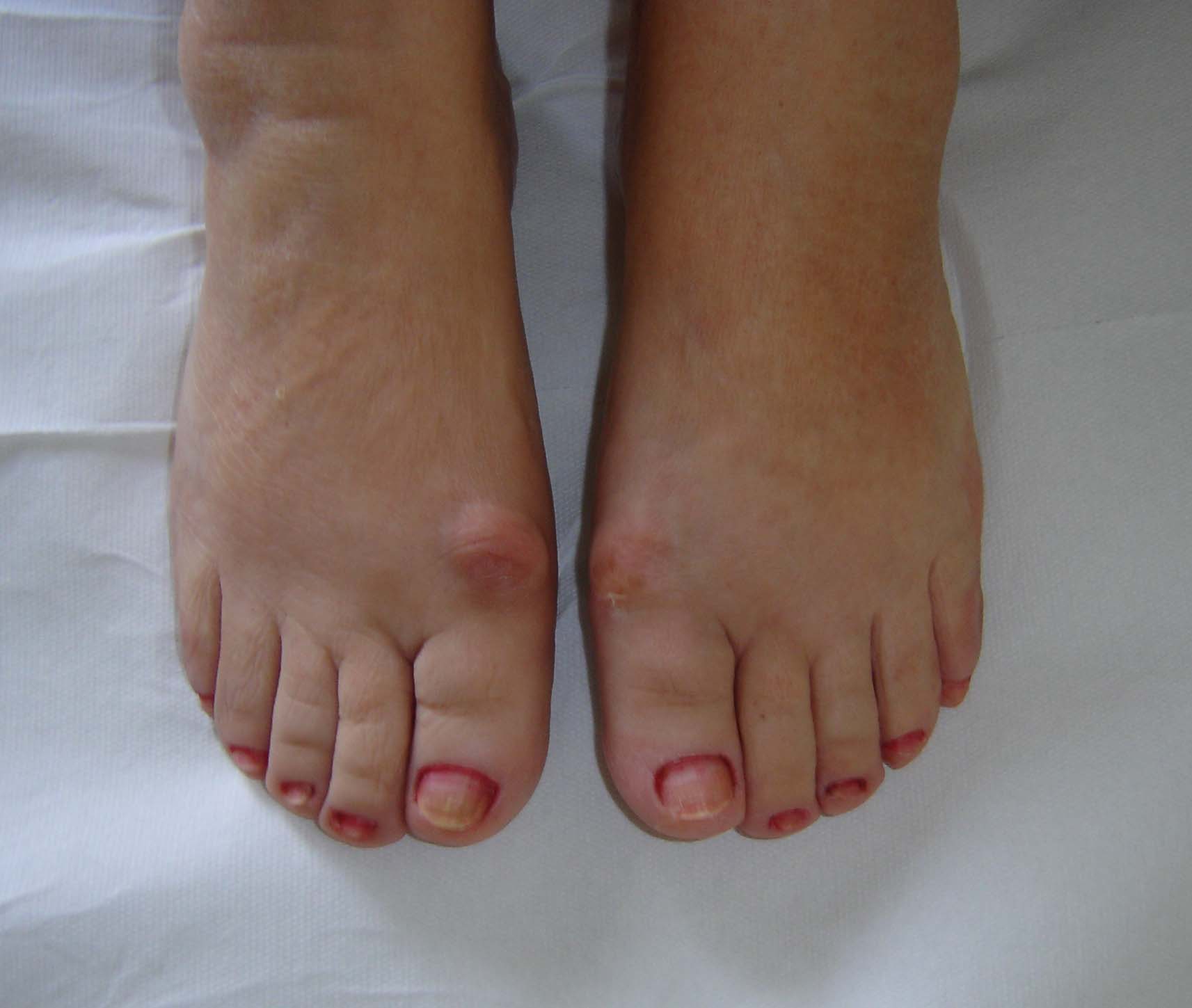 osteoartrita degetelor de la picioare