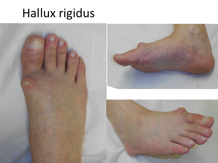 Hallux rigidus - Artroza. Cauze si tratament.