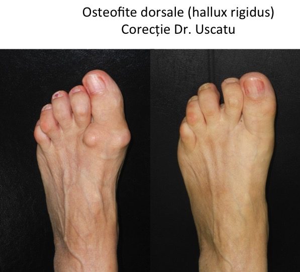 HR osteofite dorsale