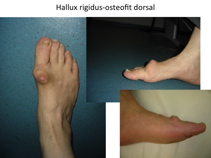 HR osteofite mari
